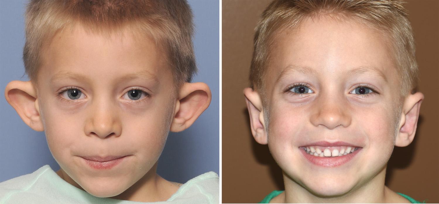 Pediatric Otoplasty